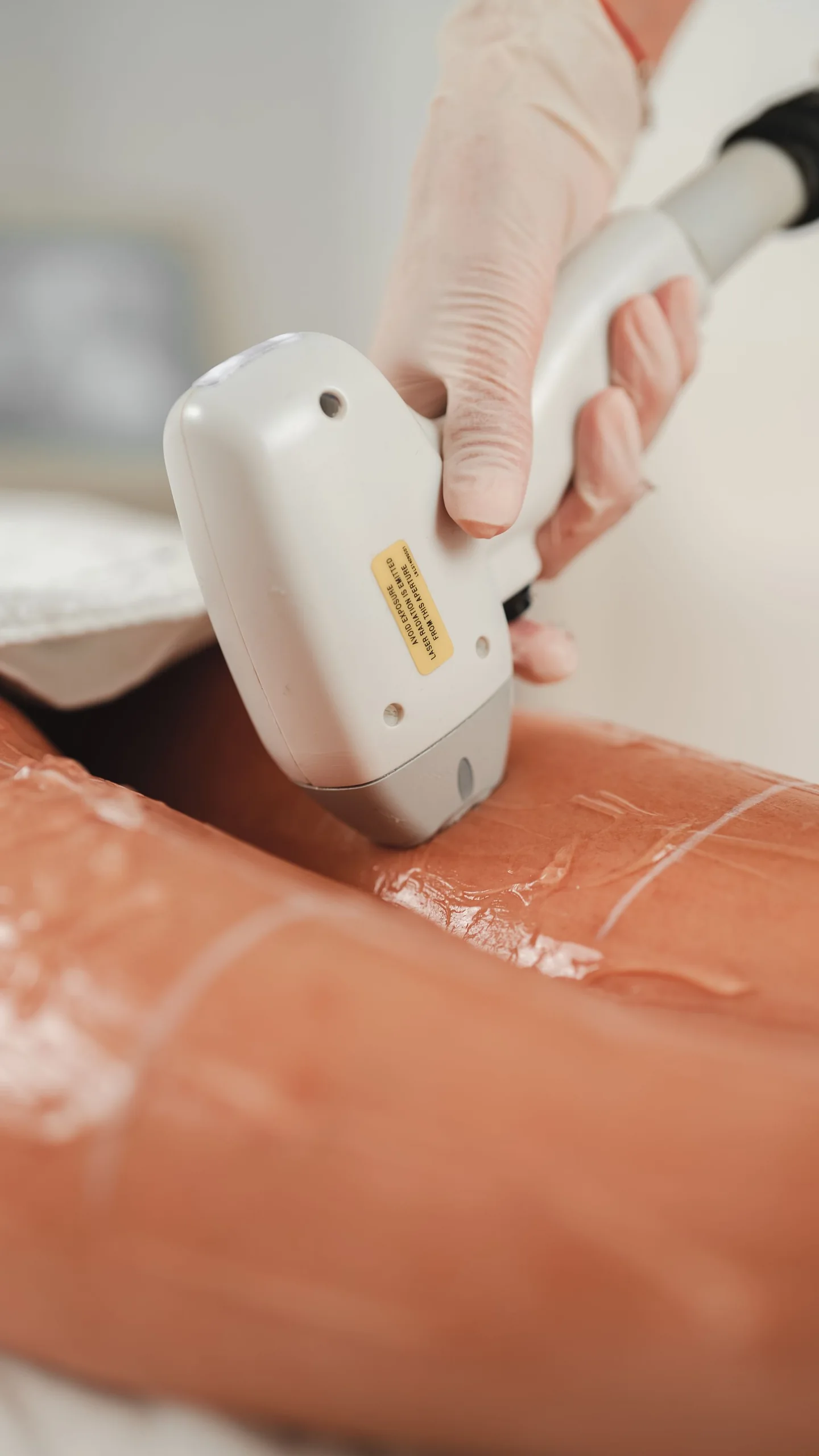 A gloved practitioner using a hair-removal handpiece on a lower leg